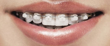 Adult Orthodontics: Clear Ceramic Braces