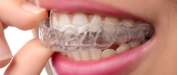 Adult Orthodontics: Invisalign