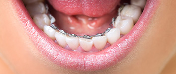Adult Orthodontics: Lingual Braces