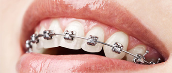Adult Orthodontics: Metal Braces