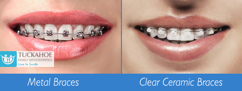 What are Ceramic Invisible Braces