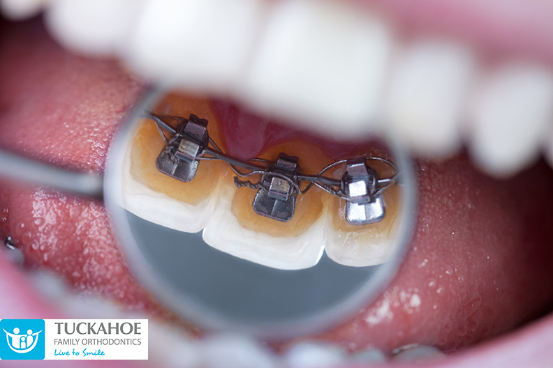 Mentor Braces