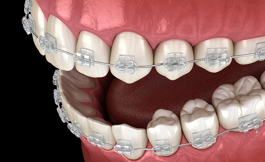 Clear Ceramic Braces Boca Raton  Ceramic Dental Braces West Boca