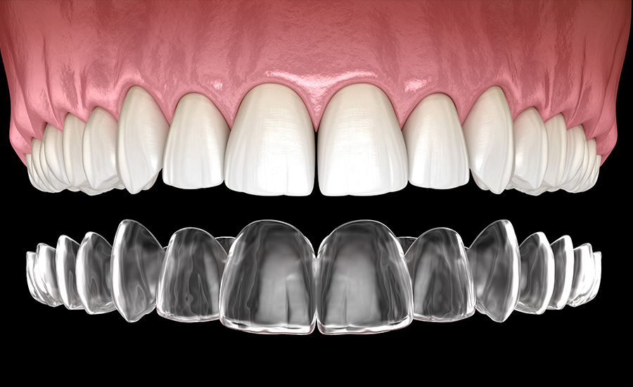 Invisalign