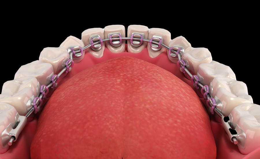 Lingual Braces In Boerne TX Boerne, TX - Complete Dental Studio