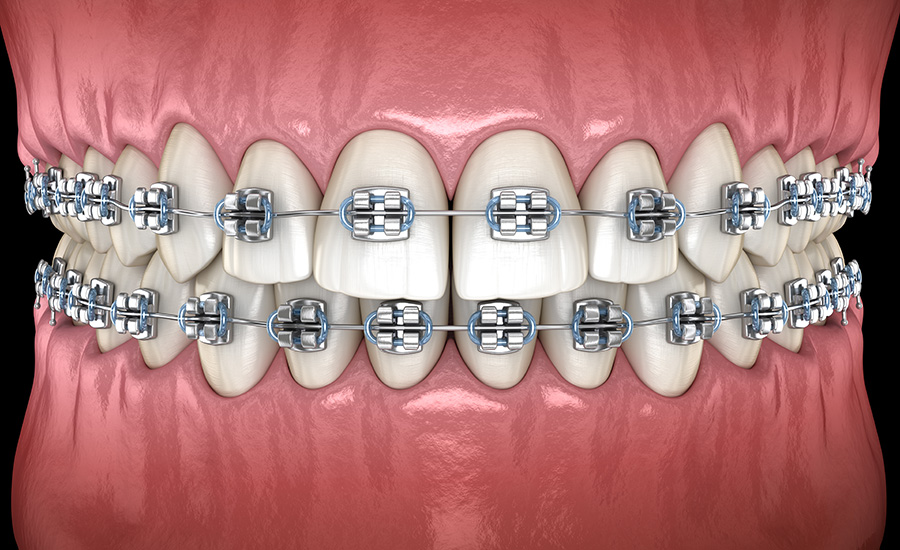 Traditional Metal Braces  Suffolk Pediatric Dentistry NY