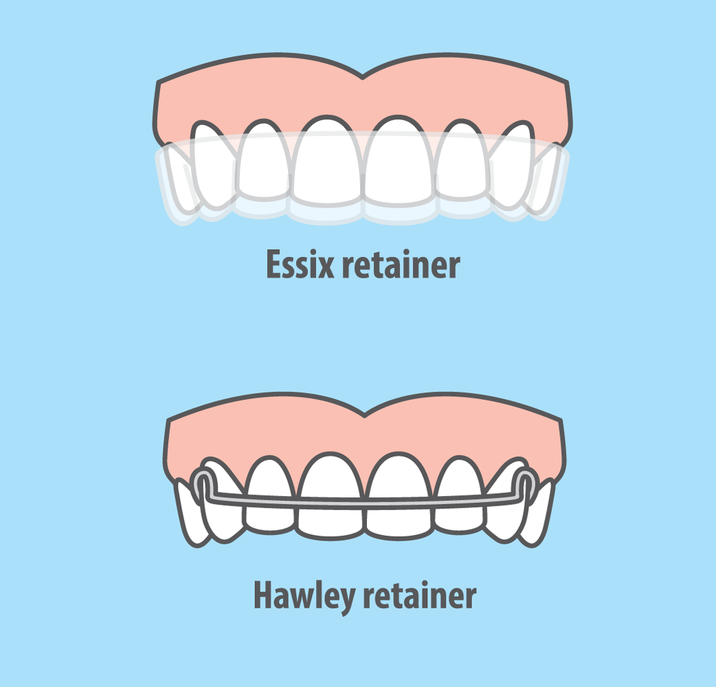 removable retainers