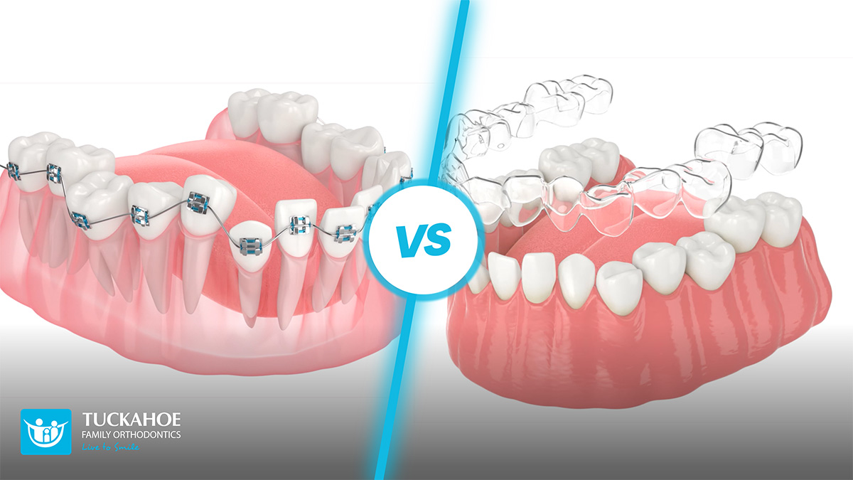 Difference Between Braces and Invisalign