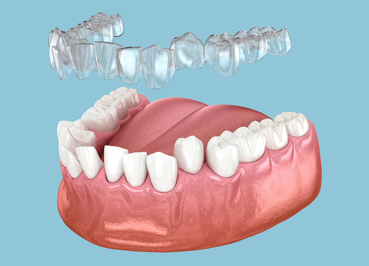 clear aligners