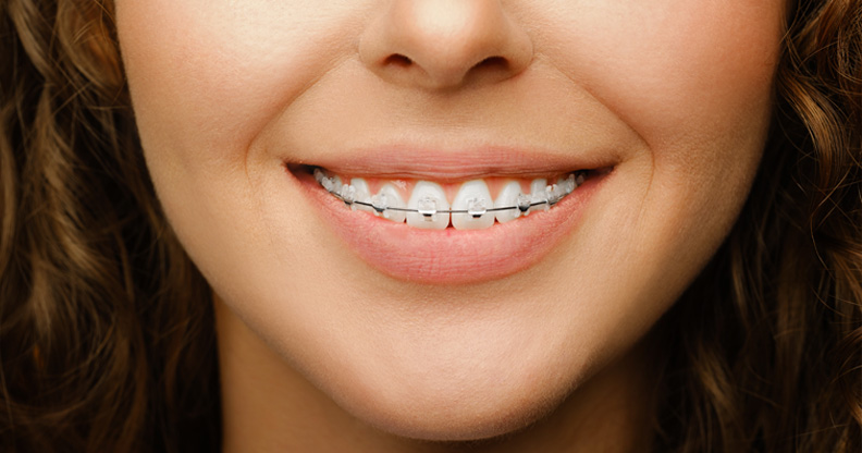 Are Metal Braces Still a Good Option